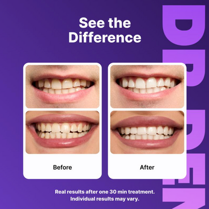 Teeth Whitening Strips